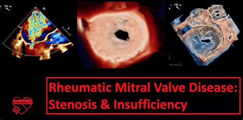 Rheumatic Mitral Valve Disease Stenosis And Insufficiency Echovision