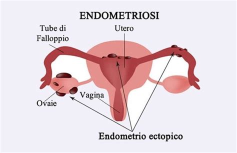 ENDOMETRIOSI SINTOMI E TERAPIA Cibum