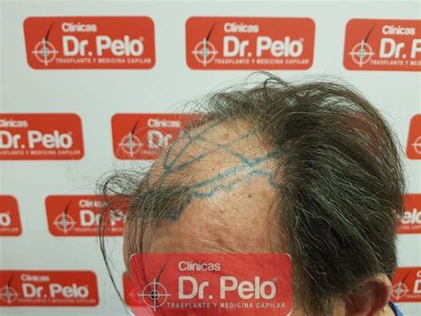 Caso Cl Nicas Dr Pelo Frontal Y Zona Media En Paciente De