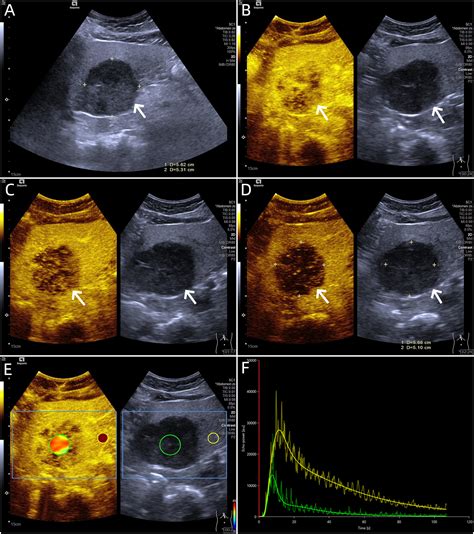 Applications Of Dynamic Contrast Enhanced Ultrasound In Differential Diagnosis Of Hepatocellular