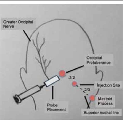 PDF Ultrasound Guided Greater Occipital Nerve Block An Efficient