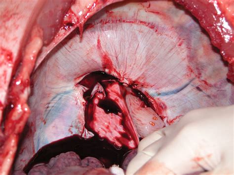 Effect Of Artificial Ascites On Thermal Injury To The Diaphragm And