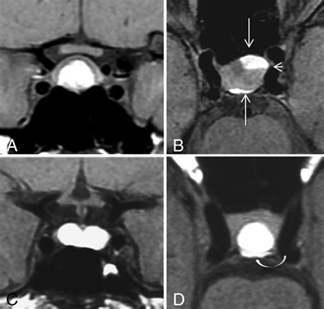 Normal Pituitary Mri T2