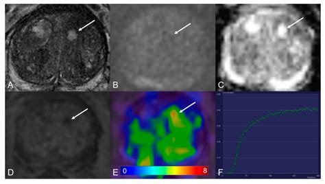 Cancers Free Full Text Dynamic Contrast Enhanced Mri Of Prostate