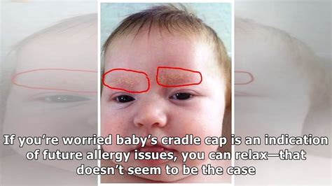 What To Do When Baby Gets A Case Of Cradle Cap Youtube