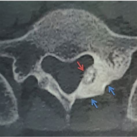 Axial Section Ct Scan Showing A Typical Oo Aspect Of The Left Lamina Of Download Scientific