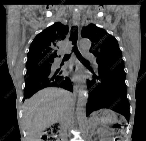 Lung Cancer Ct Scan Stock Image F Science Photo Library