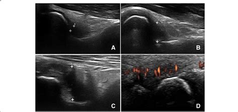 Ultrasonographic Parameters Synovitis In The Anterior Elbow A Grade