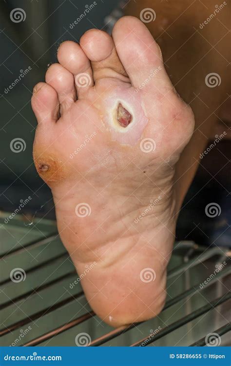 Diabetic Foot Stock Image Image Of Medical Infected 58286655