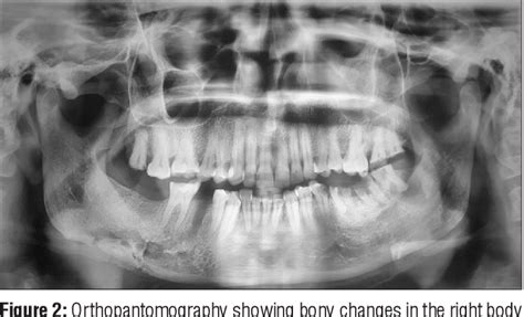 Focal Sclerosing Osteomyelitis