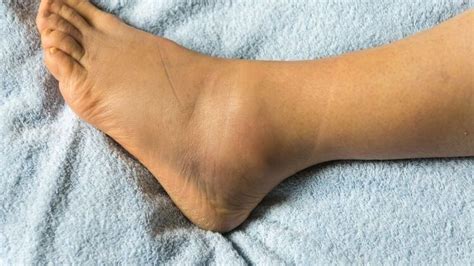 How Long Do Sprained Ankles Take To Heal