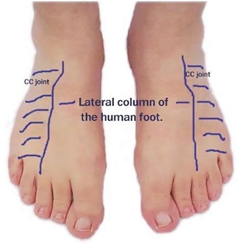 Cuboid Syndrome | Causes and treatment options - Printer friendly version