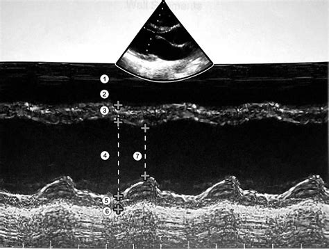 Basic Sonography M Mode Mid Ventricular Level Diagram Quizlet