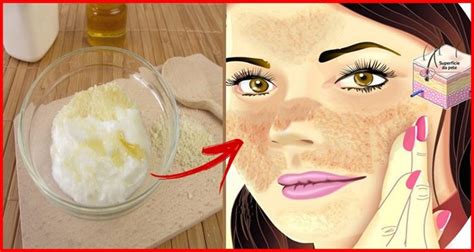 As Receitas Caseiras Para Acabar De Vez O Melasma No Rosto