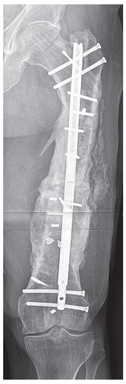 Oncologic Allograft Femur Nonunion Hss Case