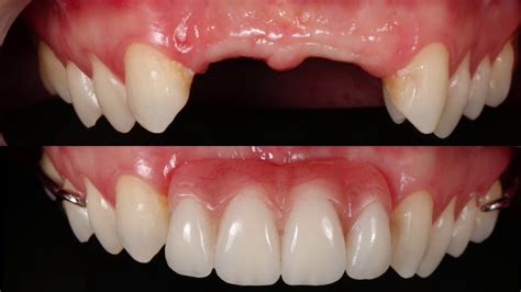 Tipos de Próteses Dentárias OdontoYama