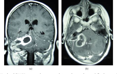 Figure 1 From Pediatric Masked Mastoiditis Associated With Multiple