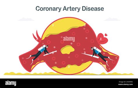 Coronary Artery Disease Treatment That Caused By Atherosclerosis More