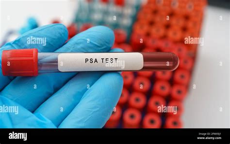 Prostate Specific Antigen Test Hi Res Stock Photography And Images Alamy