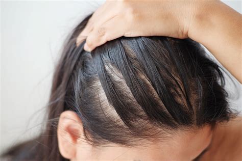 Der richtige Umgang mit Haarausfall und dünner werdendem Haar