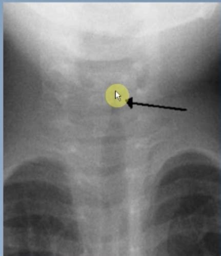 Peds Upper Airway Flashcards Quizlet