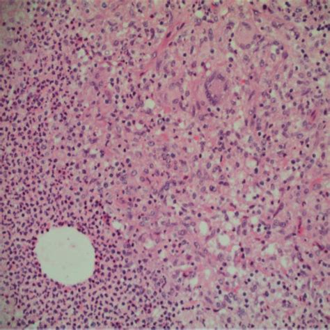 Histology Slide 2 Of The Patients Left Breast Specimen Acute Mastitis