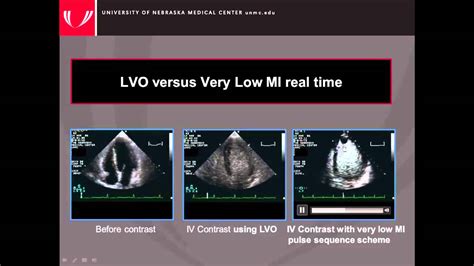 Guidelines For The Cardiac Sonographer In The Performance Of Contrast Echocardiography Youtube