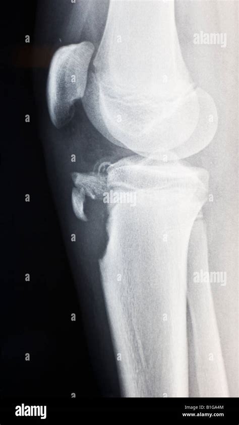 Osgood Schlatter Knee X Ray