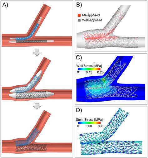 Simultaneous Kissing Stents To Treat Unprotected Left Main Stem