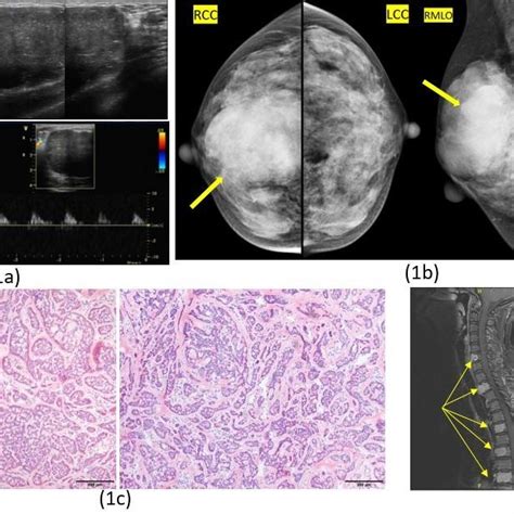 61 Year Old Woman With Adenoid Cystic Carcinoma In The Right Breast