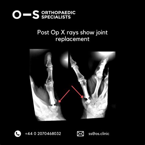 Joint Replacement of Right First Carpometacarpal Joint of the Thumb for ...