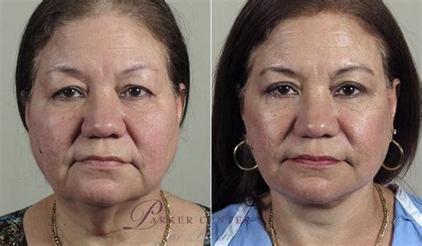 Facelift Before And After Pictures Case 41 Paramus New Jersey Parker Center For Plastic Surgery