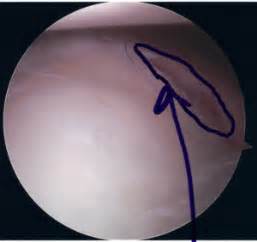 Bankart Lesion: Causes, Symptoms & Treatment