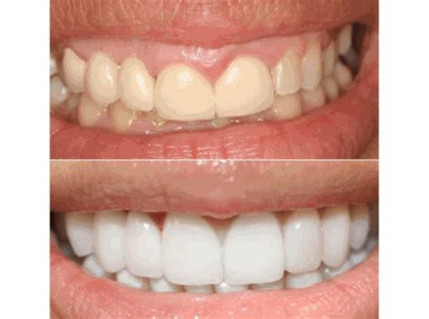 Dental Veneers Vs Crowns Which Is Better Whats The Difference