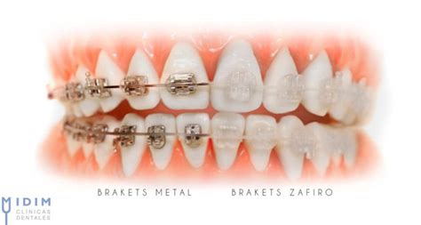 Tratamiento De Ortodoncia Invisible Tipos