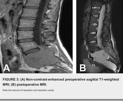 Figure 3 From A Case Report Of A Sacral Giant Cell Tumor Treated With Block Resection And Lumbo