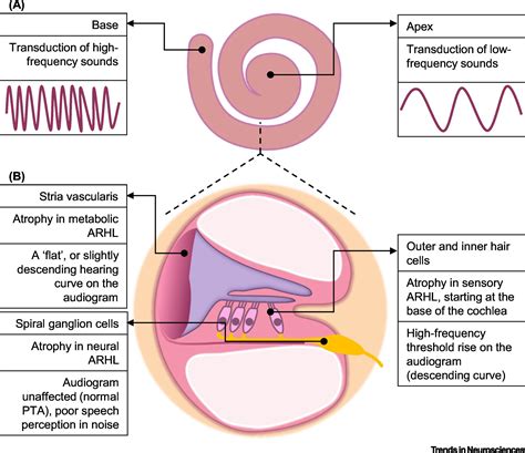 Sensorineural Hearing Loss Hair Cells