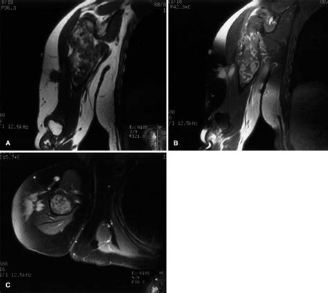 A Coronal T Weighted Image Tr Ms Te Ms Demonstrating The