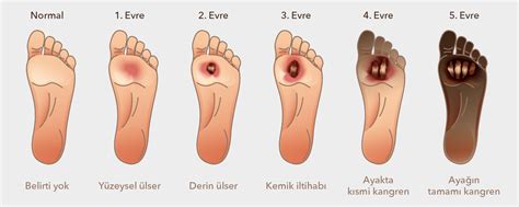 Diyabetik Ayak Yaras Ve Bakteriyofaj Tedavisi Turan Turan