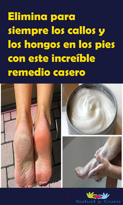 Elimina Para Siempre Los Callos Y Los Hongos En Los Pies Con Este