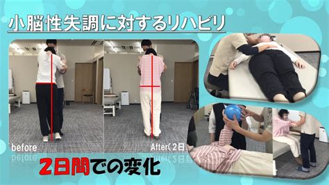 【脳卒中 失調のリハビリ】2日間での姿勢と歩容の変化とは⁉ 姿勢・眼球運動 Youtube