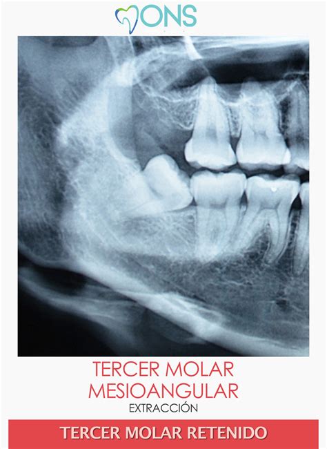 M066 Extracción de tercer molar mesioangular ODONTOFLIX net