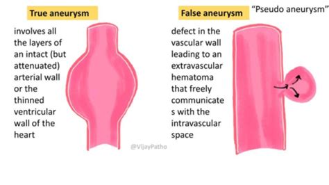 Pathology Aneurysm Flashcards Quizlet