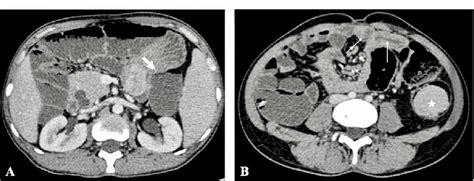 Axial Contrast Enhanced Ct Enterography Images A And B Show Large Download Scientific Diagram