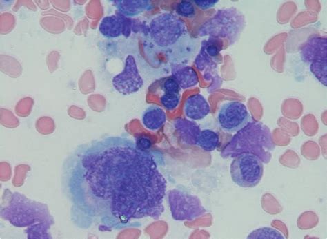 Figure 1 Bone Marrow Aspiration Of The Patient It Showed