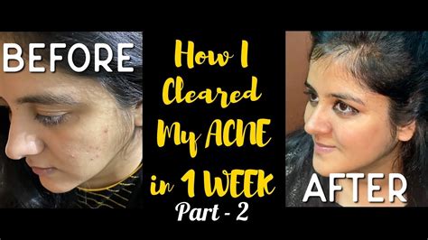 Face Pack To Remove Pimples In 1 Week Pimple को बोलो Bye Bye Youtube