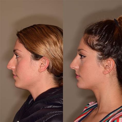 Nonsurgical Rhinoplasty Vs Surgical Rhinoplasty