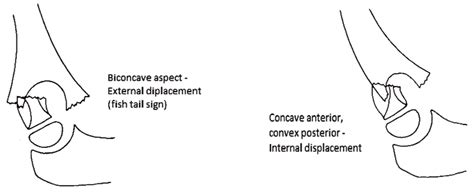 radiographic appearance  external rotation displacement