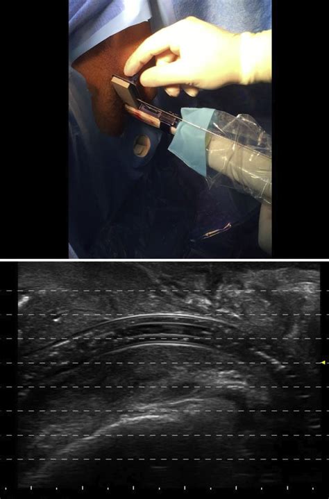 Transperineal Interstitial Laser Ablation Of The Prostate A Novel Option For Minimally Invasive