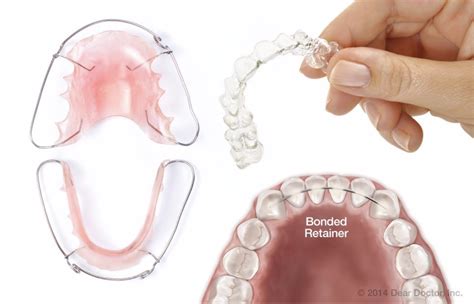 How to Properly Clean Orthodontic Retainers